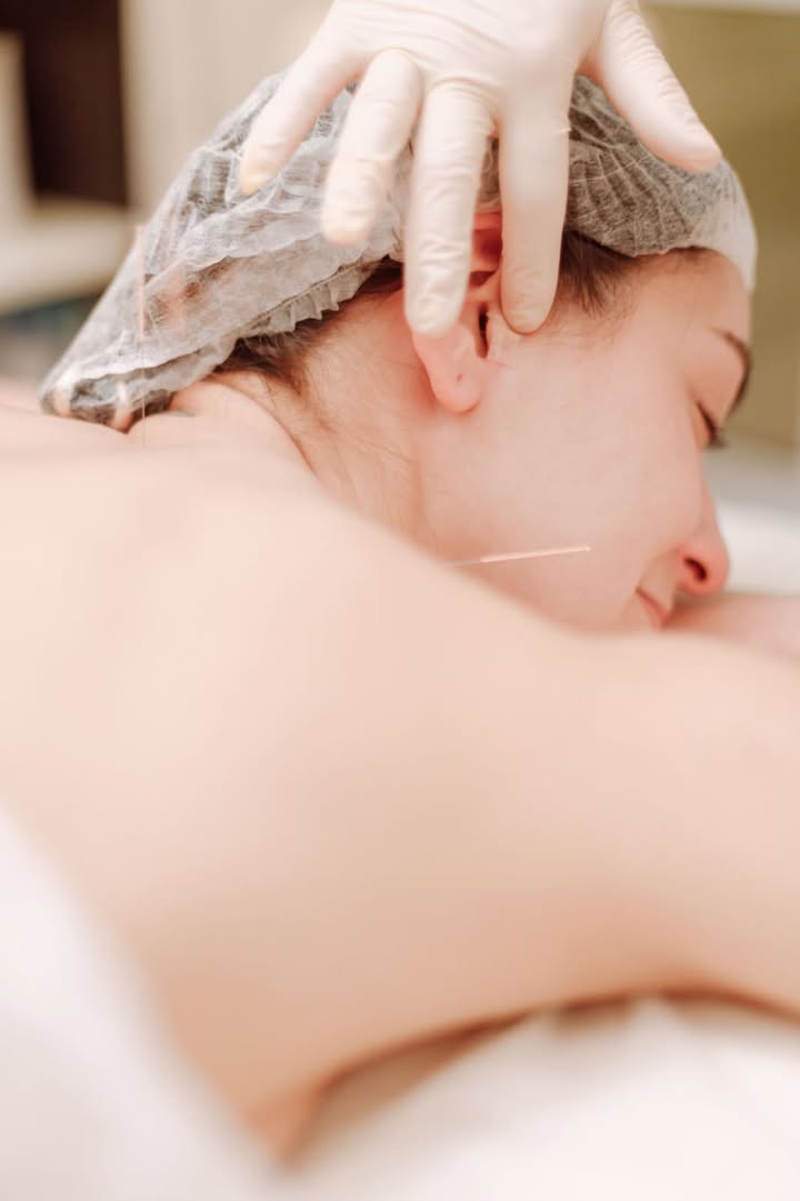 Cosmetic Acupuncture Instead of Beauty Injections