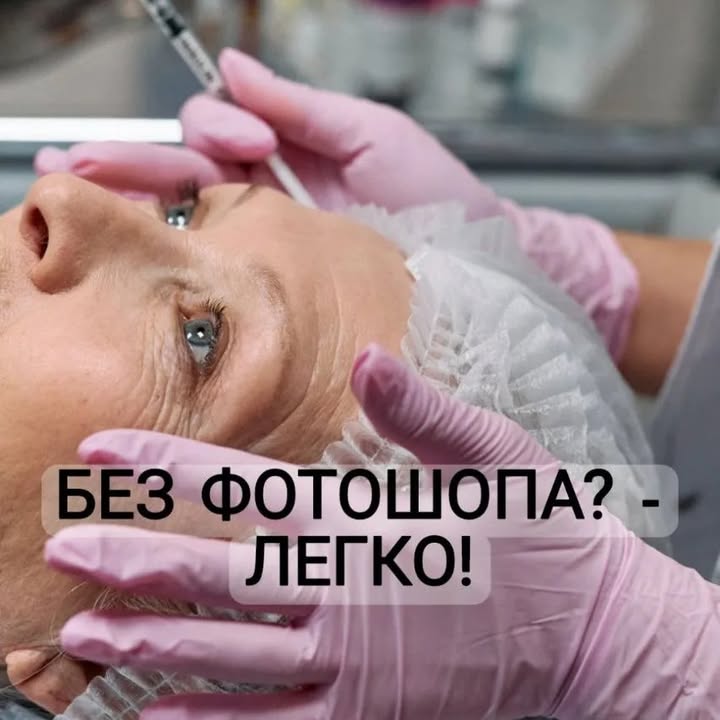 Forehead Wrinkles, Nasolabial Folds and Carboxytherapy