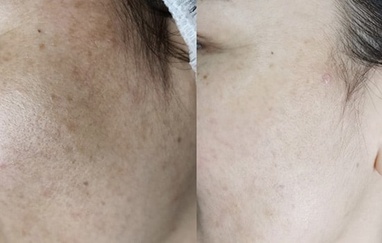 Facial Cleansing