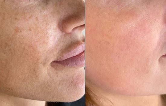 Facial Peeling