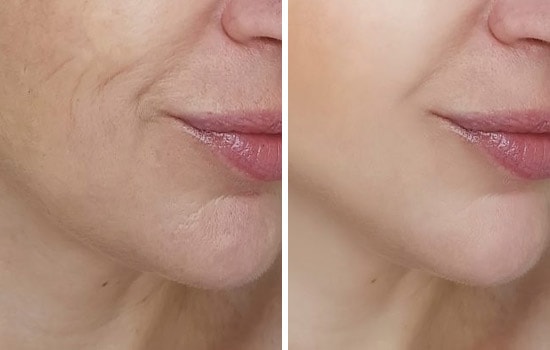 Plasmolifting (PRP Therapy)